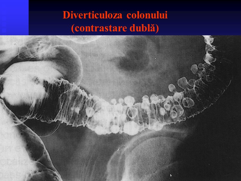 Diverticuloza colonului (contrastare dublă)